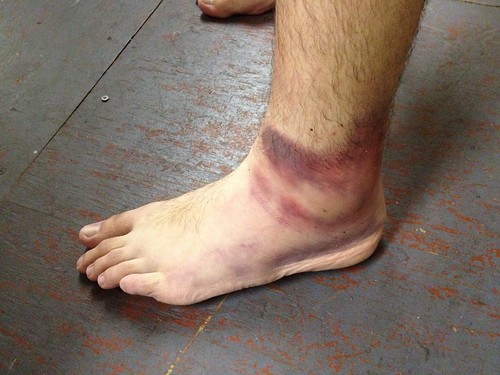 Victory <s>ankle roll</s> tendon tear ©  Jason Eppink
