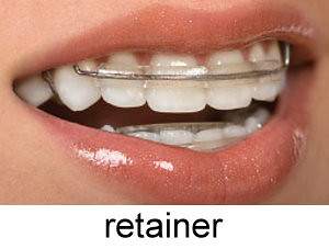 retainer-on-teeth-orthodontic.jpg