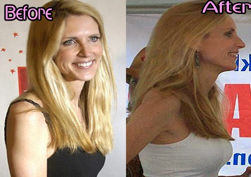Ann Coulter Plastic Surgery Nose Job, Facelift, Botox Before and After Photos