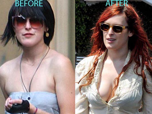 Rumer Willis Plastic Surgery Before After
