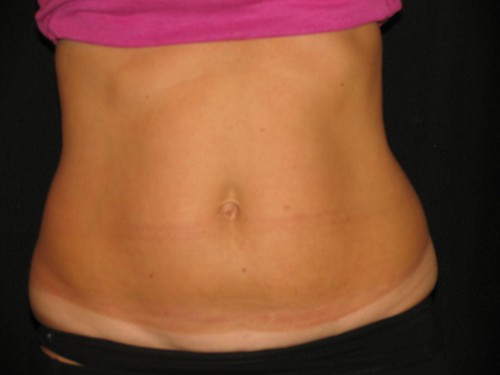 coolsculpting SimplySkin after by Towne Post Network, on Flickr