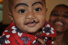 Before cleft lip surgery • <a style="font-size:0.8em;" href="http://www.flickr.com/photos/109076046@N08/16700920886/" target="_blank">View on Flickr</a>